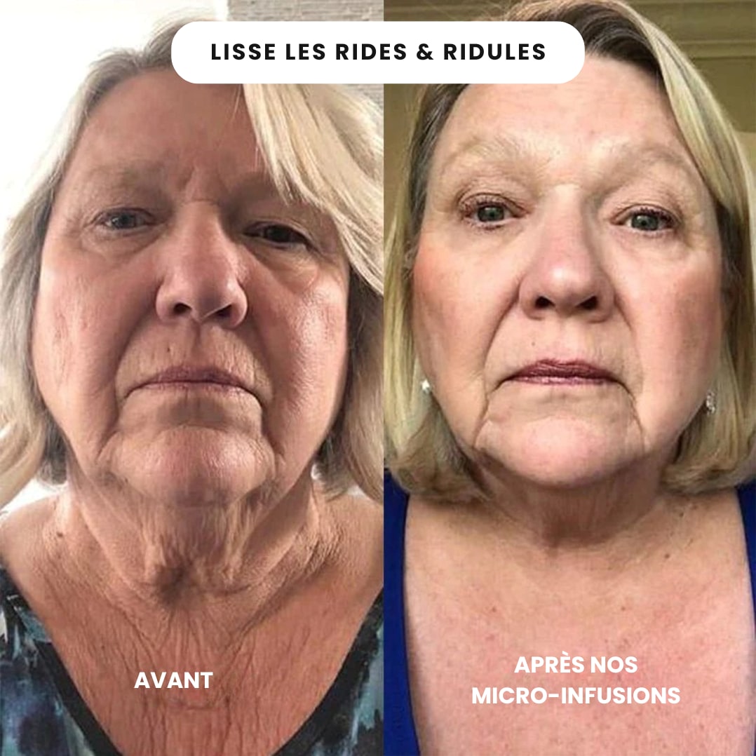 Micro Infusion Anti Âge