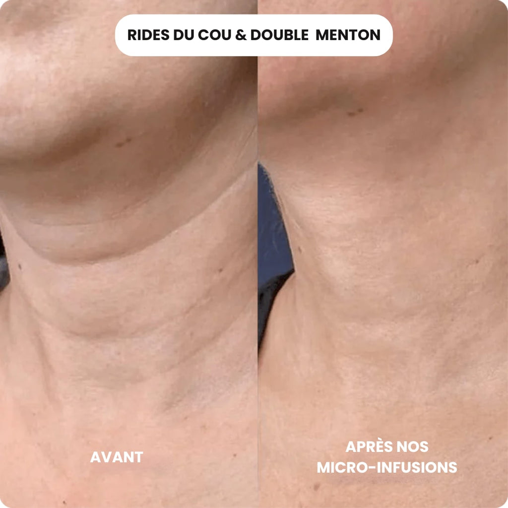 Micro Infusion Anti Âge